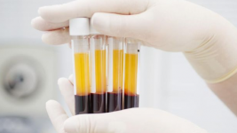 Plasma Darah Bisa Bantu Mengukur Keparahan Pasien Covid-19, Begini Caranya