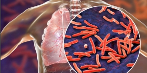 Fakta-fakta Penyakit TBC di Indonesia, Kemenkes: 11 Orang Mati setiap 1 Jam