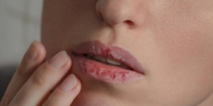 Cara Mengatasi Bibir Pecah-pecah dan Kering